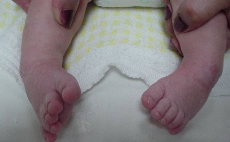 Casi 1.000 niños reciben tratamiento gratuito a través de „Pie bot Paraguay“